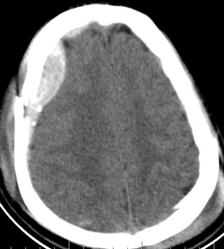 Acute EDH and SDH – criticalcareinsights.com